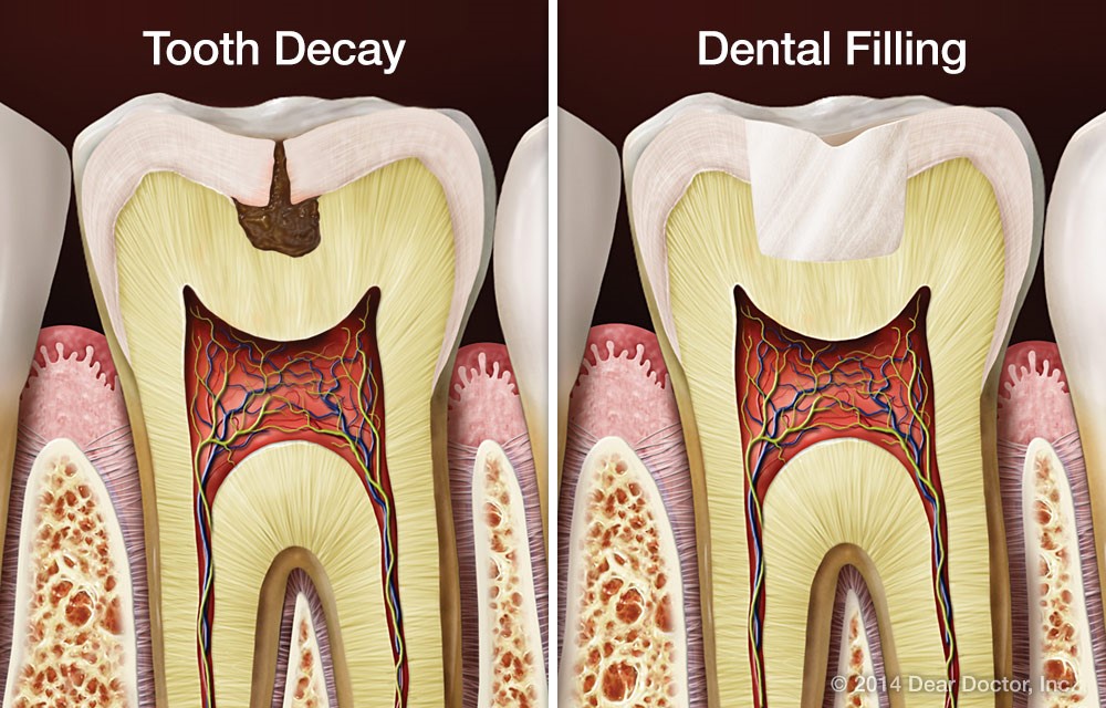 tooth enamel restoration price