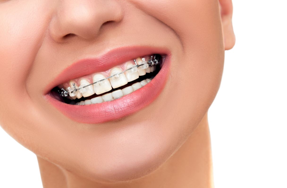 FastBraces and Invisalign Which braces are best? Simply Dental