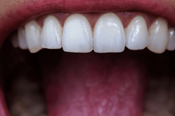dental erosion