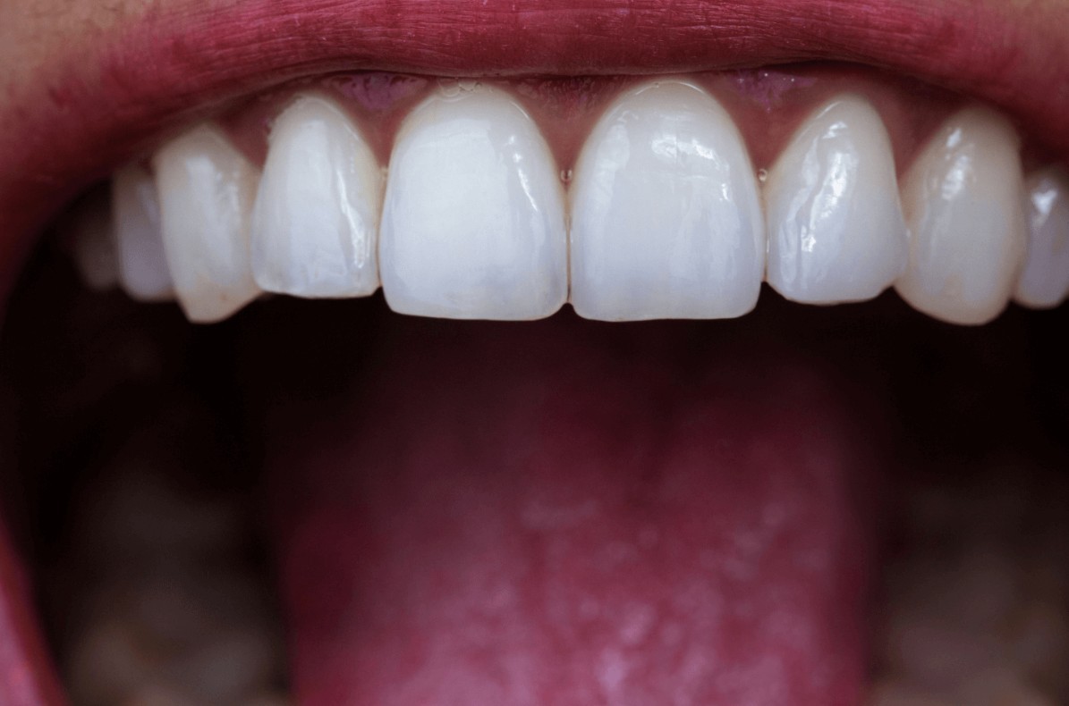 dental erosion